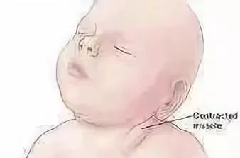 颈痛相关 自己不痛别处痛的胸锁乳突肌