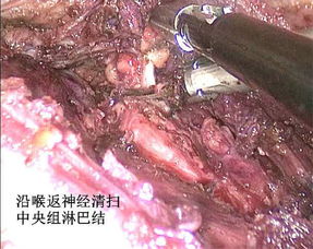 甲状腺癌颈部高清图片