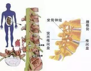 颈腰椎病,根据六部法全治好了