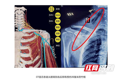 株洲女子摘菜时不慎摔倒 竟被20厘米竹棍贯穿胸颈部