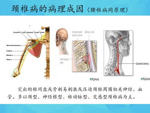 办公室一族颈 腰椎病 的 预防 及运动疗法 健康图